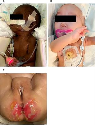 Case report: a premature infant with severe intrauterine growth restriction, adrenal insufficiency, and inflammatory diarrhea: a genetically confirmed case of MIRAGE syndrome